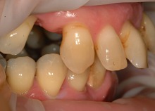 Full Upper Implant Bridge 2