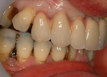 Full Upper Implant Bridge 3