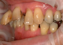 Full Upper Implant Bridge 4