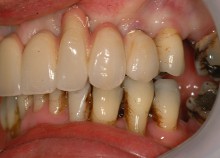 Full Upper Implant Bridge 5