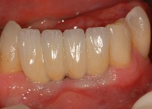 Implant Bridge Replacing Lower Incisors