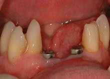 Implant Bridge Replacing Lower Incisors