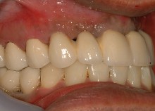 Implant Bridges