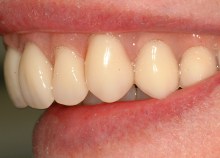 Implant Retained Dentures