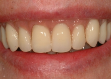 Implant Retained Dentures