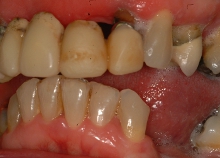 Implant Retained Dentures