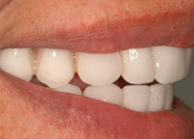 Upper and Lower Implant retained dentures