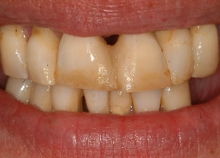 Upper and Lower Implant retained dentures